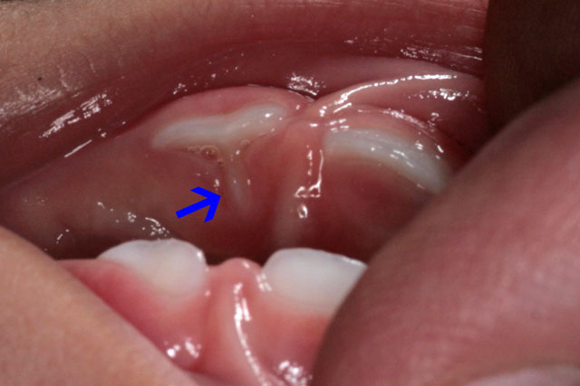 乳前歯の裏に生えた過剰歯らしき歯